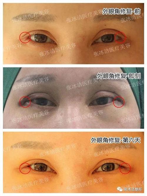 外眼角开大视频,打造迷人双眼