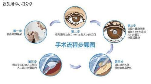 白内障手术过程视频,高清视频带你直观了解手术过程